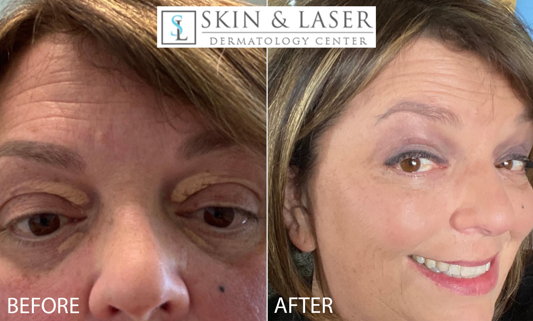 Xanthelasma