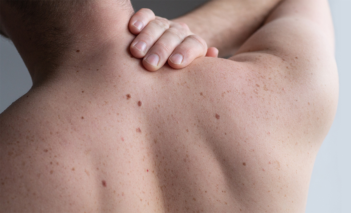 Age Spots (Solar Lentigo)