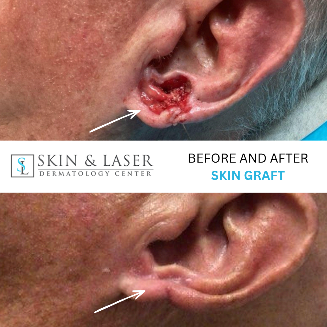 Basal cell carcinoma on the ear