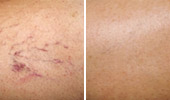 Broken Capillaries & Dilated Blood Vessels