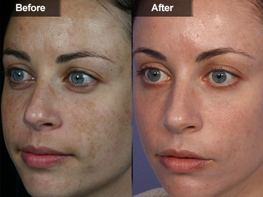 Rejuvenation-Treatments-030