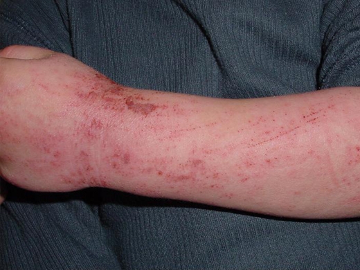 Eczema-Atopic-Dermatitis-020