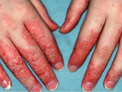 Eczema-Atopic-Dermatitis-040