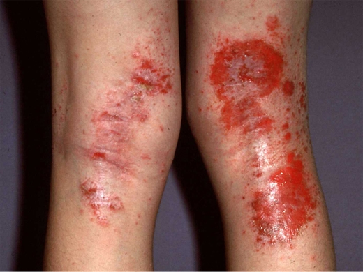 Eczema-Atopic-Dermatitis-050