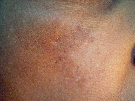 Hyperpigmentation-Melasma-030