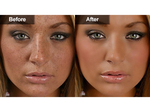 Hyperpigmentation-Melasma-040