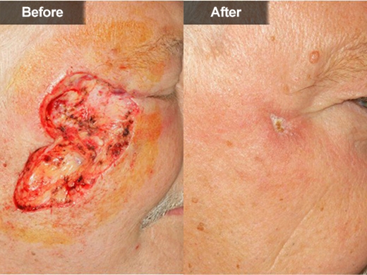Mohs Surgery clinical photo