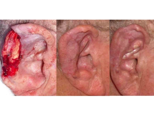 Mohs Surgery clinical photo