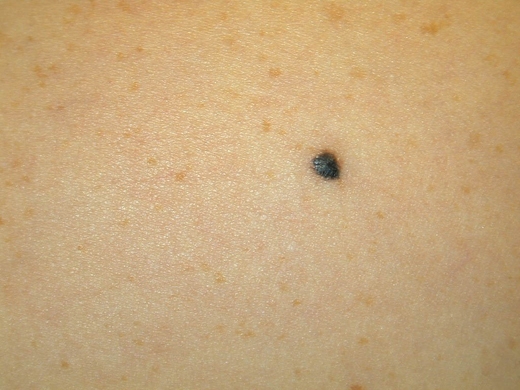 Moles, Atypical Moles & Melanoma clinical photo