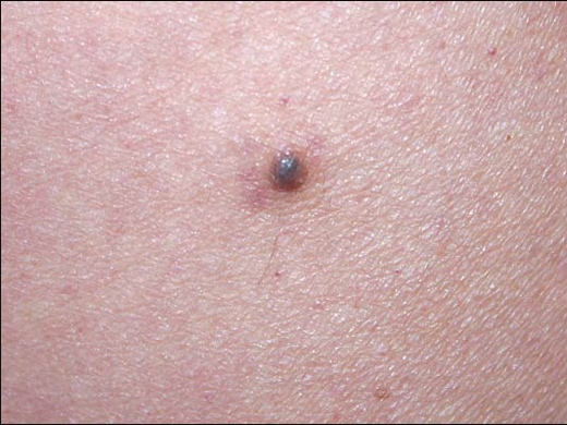 melanotan darkes moles Moles, Atypical & Melanoma Dietary Needs