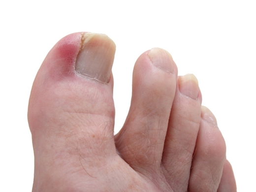 Nail Abnormalities clinical photo