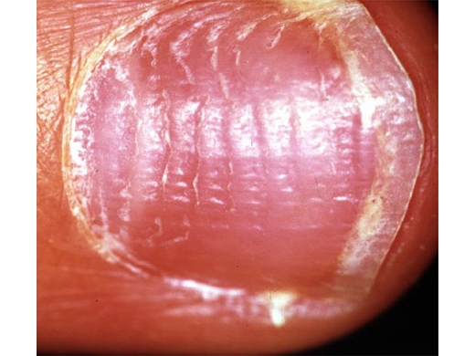 Nail Abnormalities clinical photo