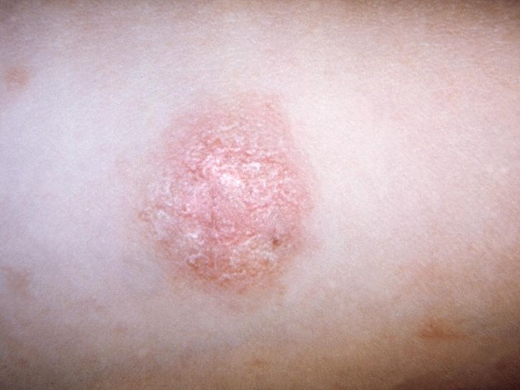 Rashes clinical photo