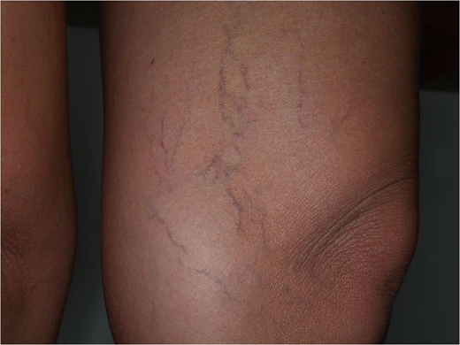 Spider Veins clinical photo