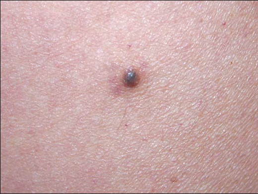 Moles Atypical Moles And Melanoma Mclean And Woodbridge Virginia