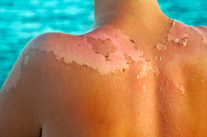 Sunburn And Skin Cancer - Skin &amp; Laser Surgery Center