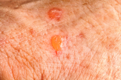 Actinic Keratosis