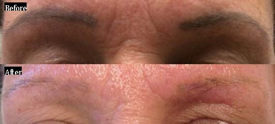 Permanent Make-Up Tattoo Removal