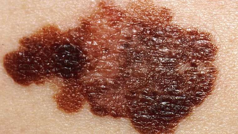 Melanoma