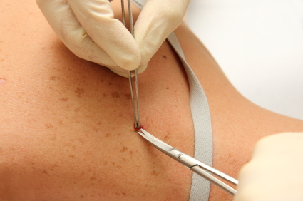 Melanoma Tests and Procedures