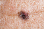 Moles And Melanoma