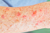 Non Melanoma Skin Cancer And Actinic Keratosis