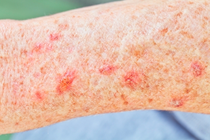 How to Spot Skin Cancer: What Does Skin Cancer Look Like and Is It Itchy?