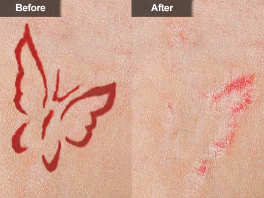 Anything I can do to minimize the scarring from laser tattoo removal   rSkincareAddiction