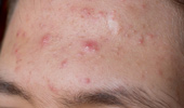 Acne Scarring Treatment