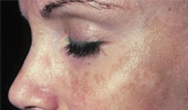 Hyperpigmentation & Melasma