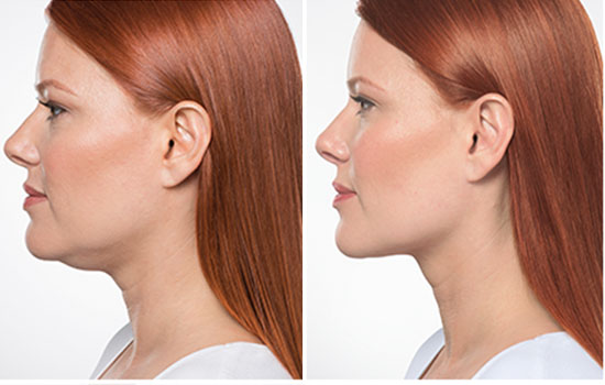 Double Chin Reduction – KYBELLA