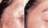 Age & Brown Spots Removal