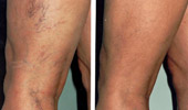 Sclerotherapy (Leg Vein Treatment)