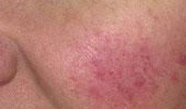 Rosacea Specialist