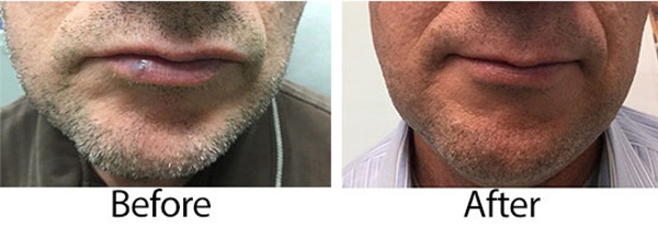 Laser Treatment for Venous Lake (purple or blue bumps on the lips)