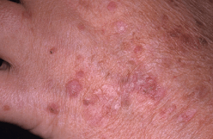 What are actinic keratoses?