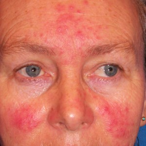 It’s Rosacea Awareness Month!