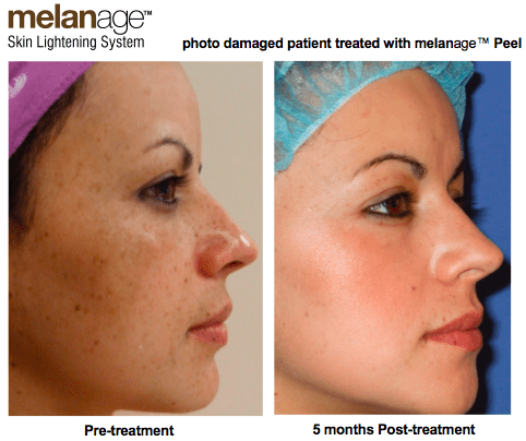 Melanage Ultra Peel for Melasma and Brown Spots