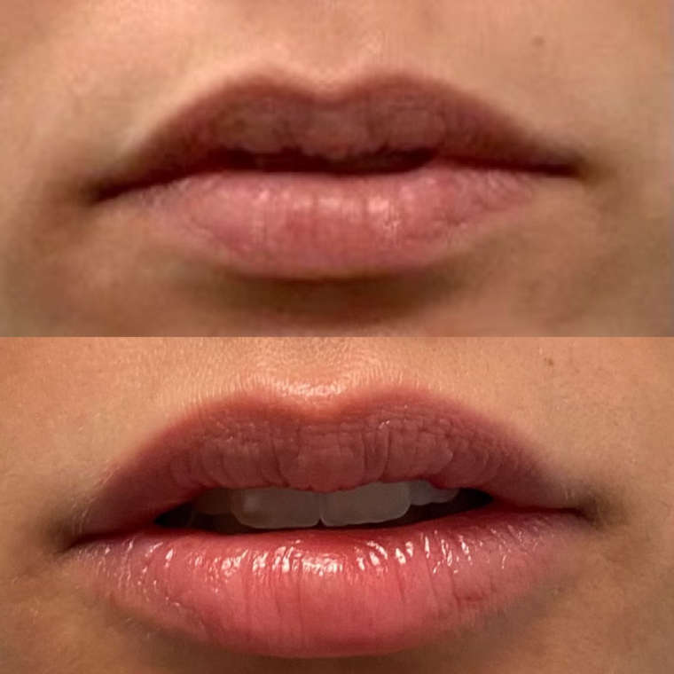 Restylane Kysse (lipfiller) Mclean VA & Woodbridge, VA Skin & Laser Dermatology Center