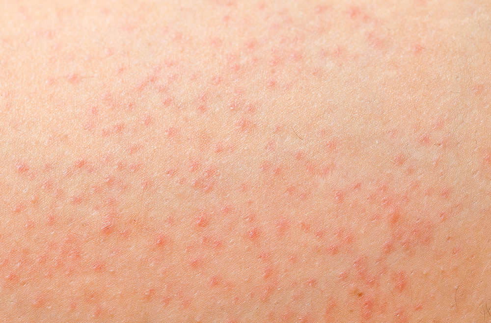 Folliculitis