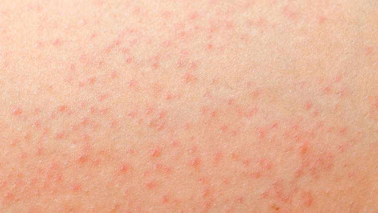 Folliculitis