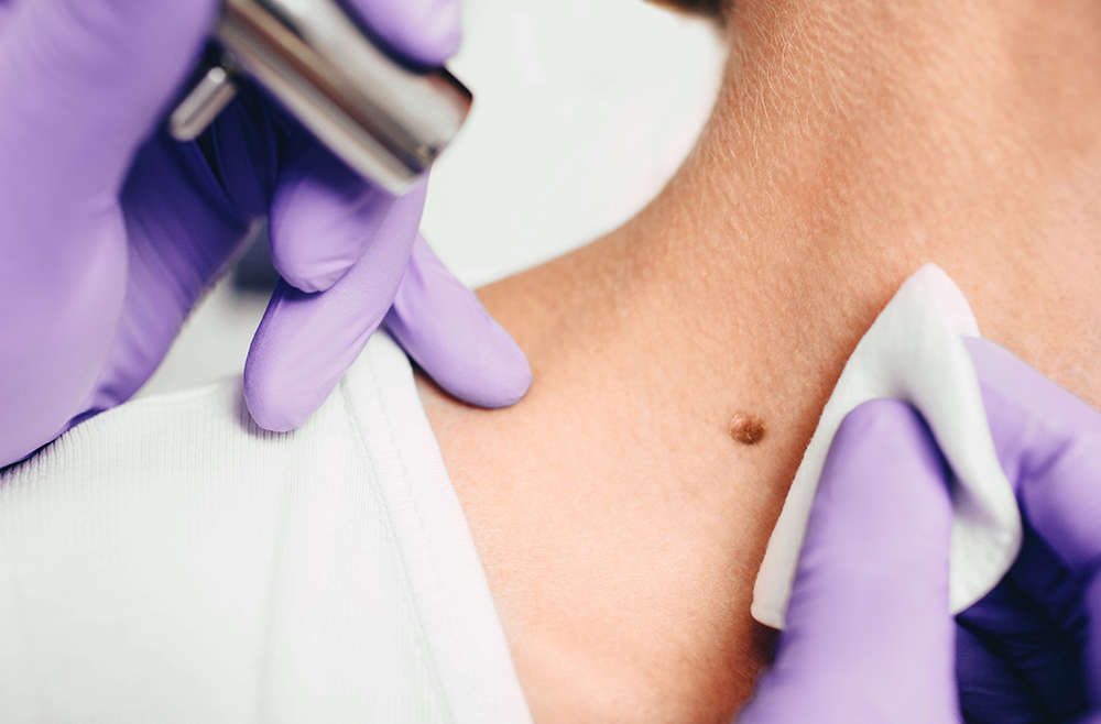 Benign Moles and Mole Removal | DPN