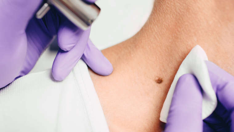 Benign Moles and Mole Removal | DPN