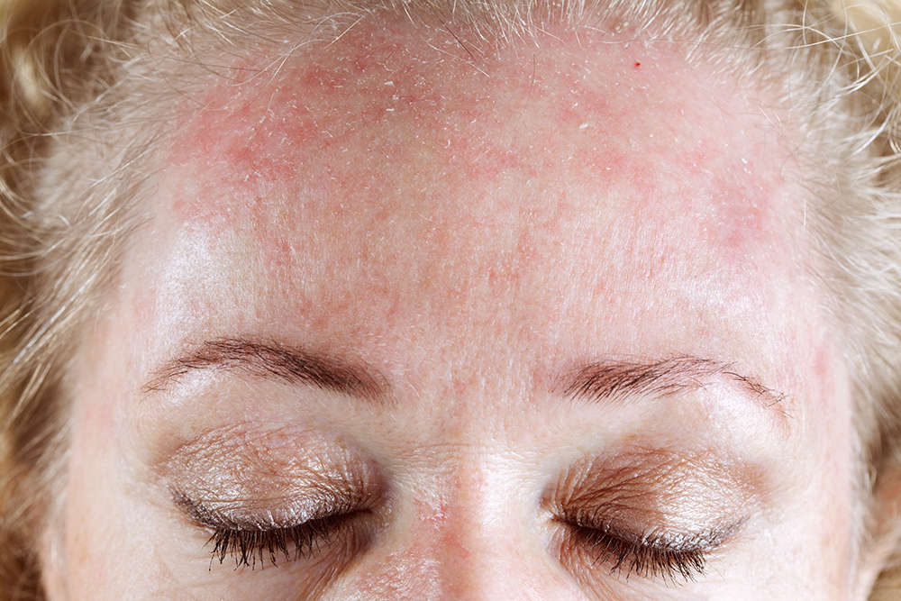 Seborrheic eczema discount