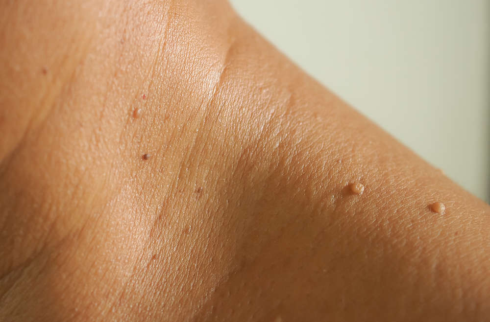 Skin Tags Removal