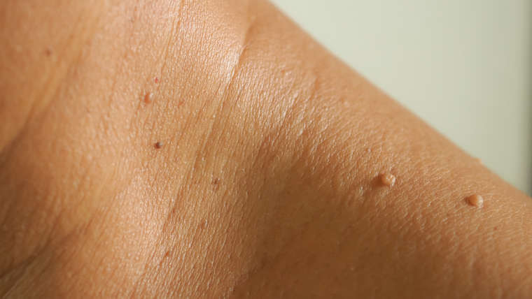 Skin Tags Removal