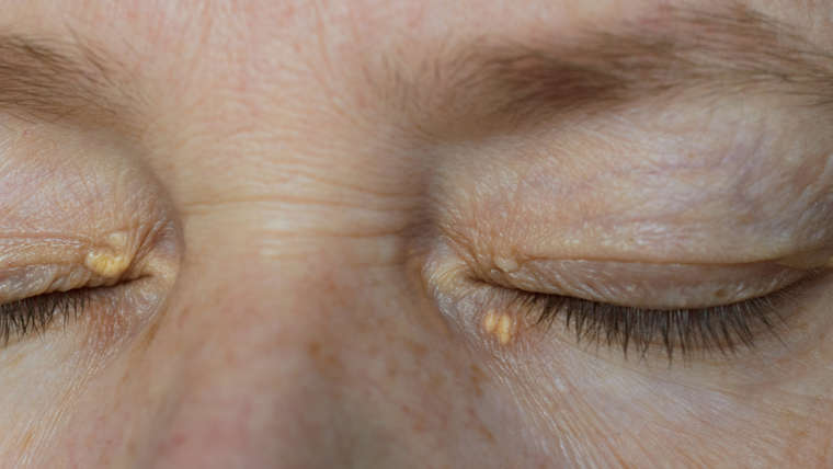 Xanthelasma