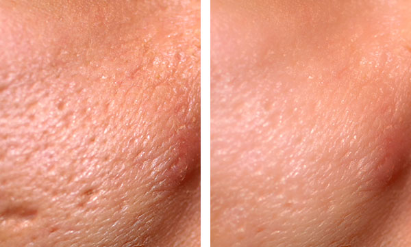 Skin Laser Resurfacing