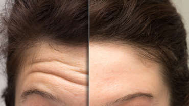 Forehead Lines Treatment