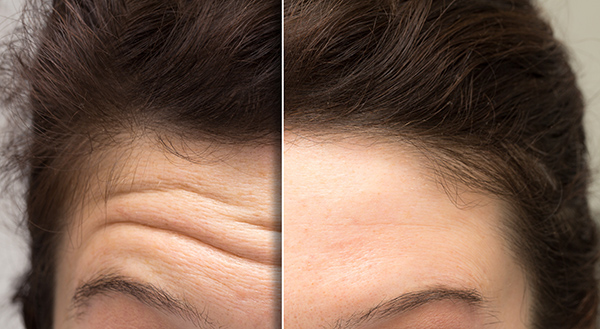 Forehead Lines Treatment